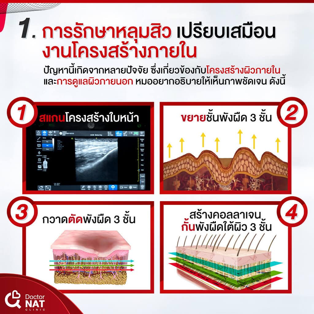 โปรแกรมเบลอขอบหลุมสิว ไม่ใช้เลเซอร์ PCI Resurface Doctor NAT Clinic