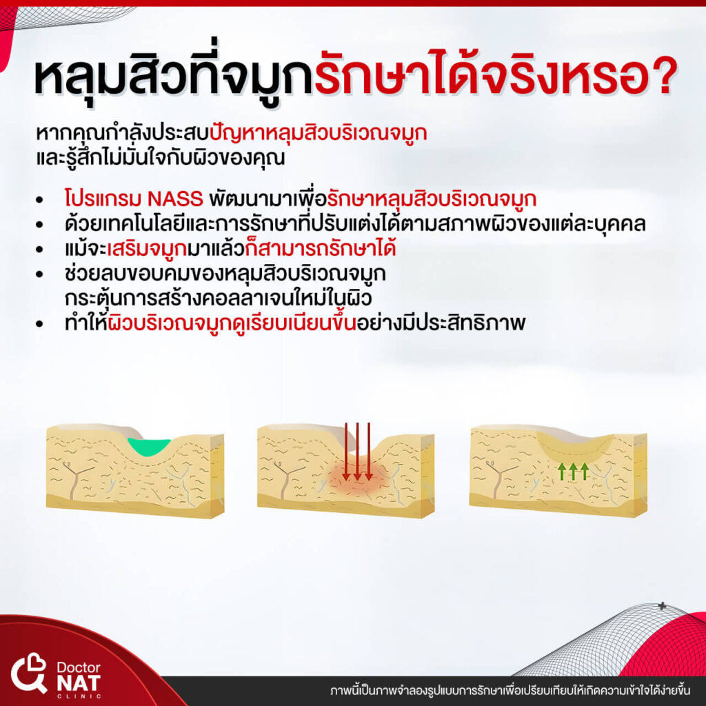 NASS for Nose Surgery Doctor NAT Clinic