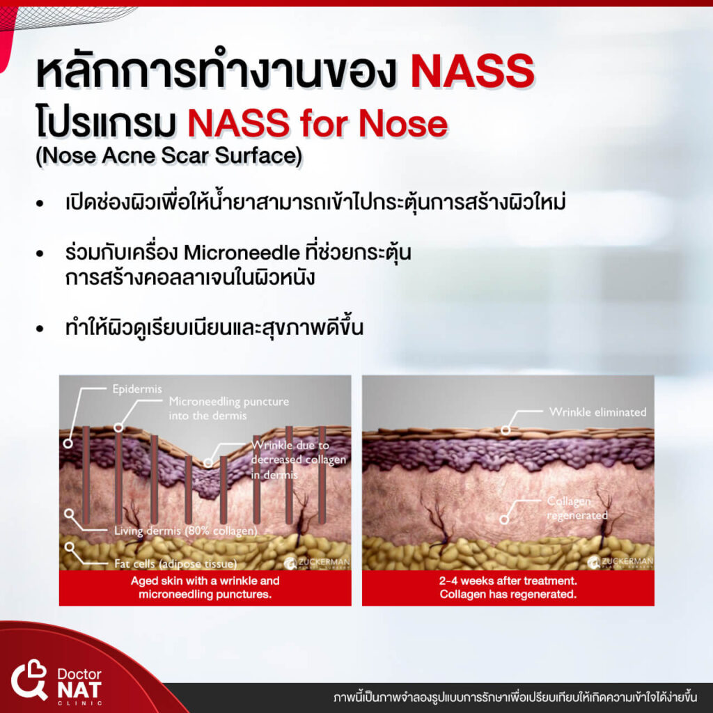 NASS for Nose Surgery Doctor NAT Clinic