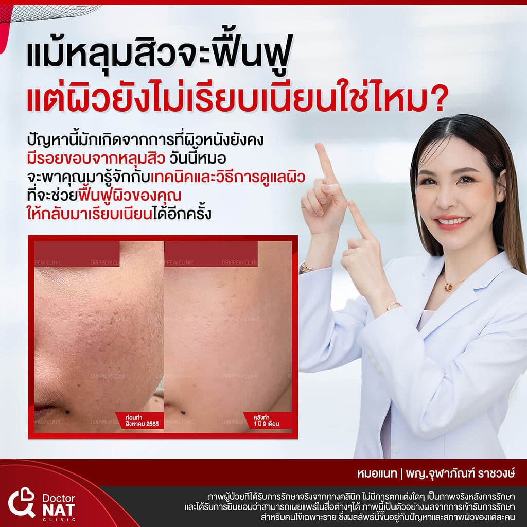 โปรแกรมเบลอขอบหลุมสิว ไม่ใช้เลเซอร์ PCI Resurface Doctor NAT Clinic