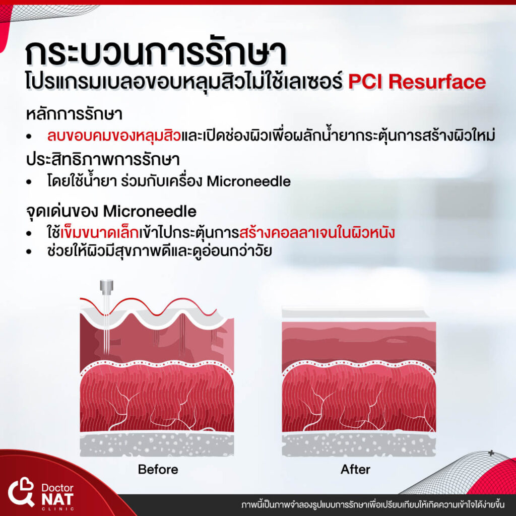 โปรแกรมเบลอขอบหลุมสิว ไม่ใช้เลเซอร์ PCI Resurface Doctor NAT Clinic