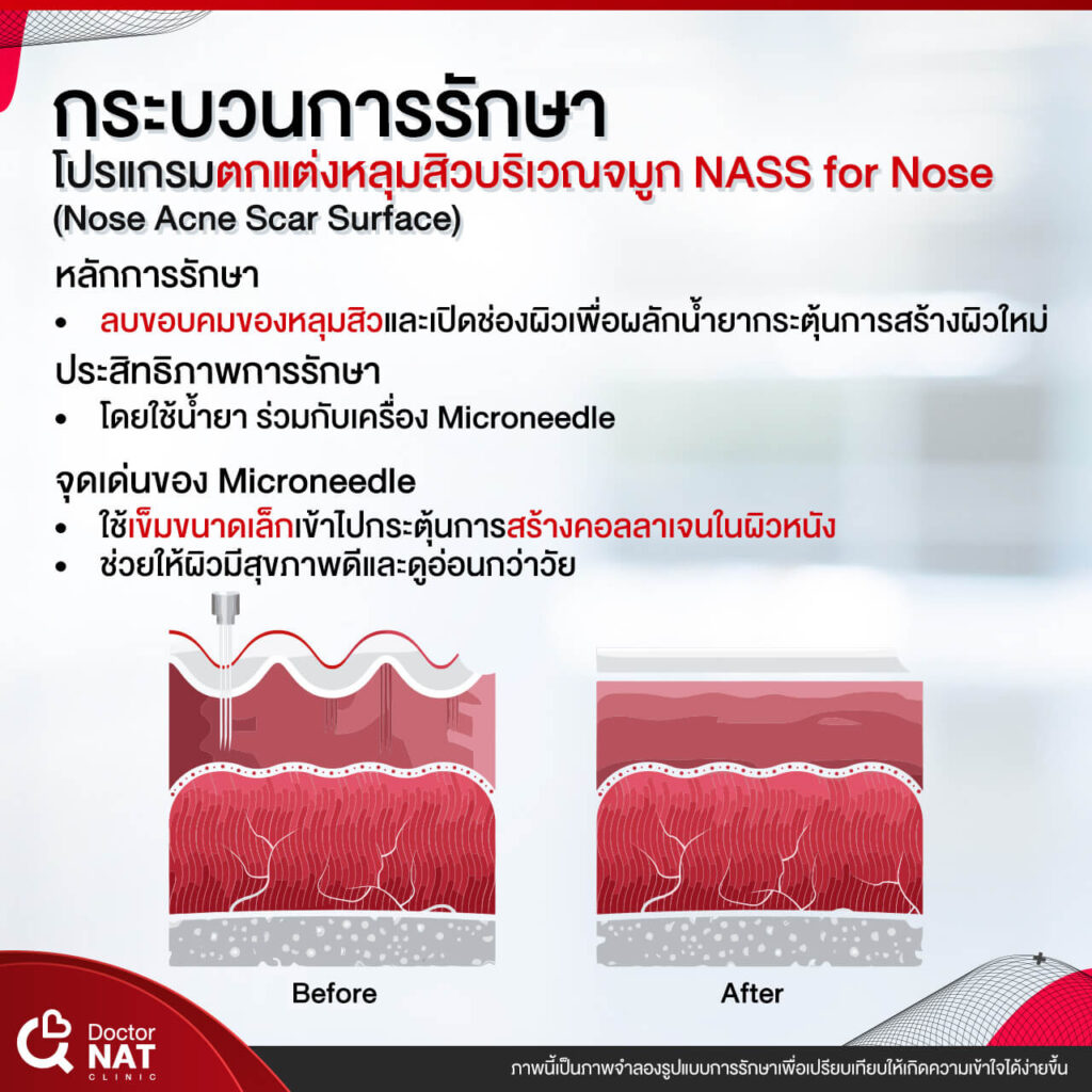 NASS for Nose Surgery Doctor NAT Clinic