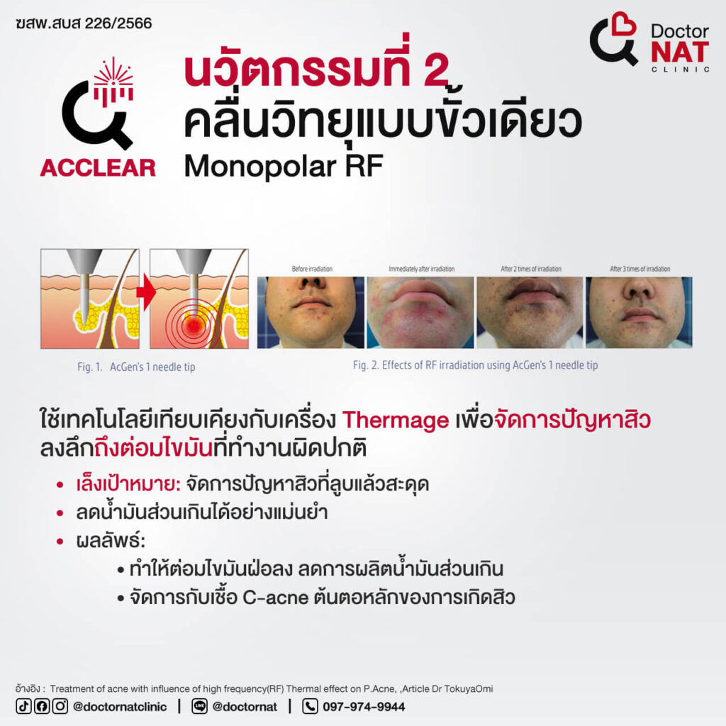 ACCLEAR โปรแกรมรักษาสิว ผสาน 2 เทคโนโลยี