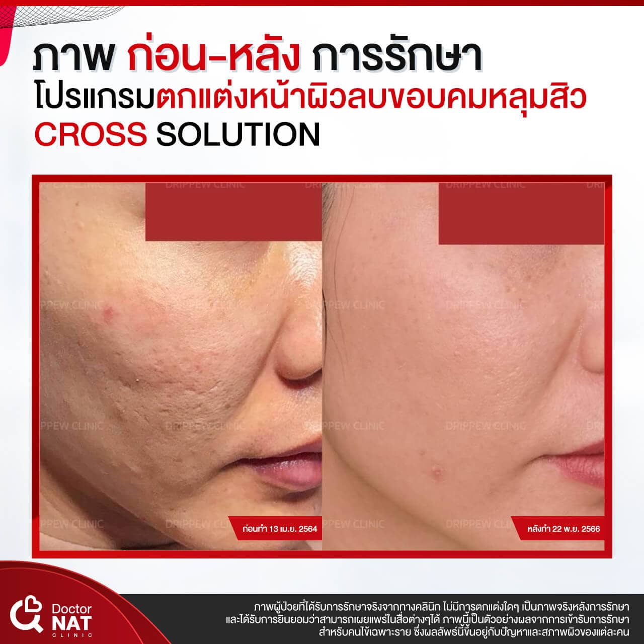 โปรแกรมตกแต่งหน้าผิวลบขอบคมหลุมสิว Cross Solution - Doctor NAT Clinic