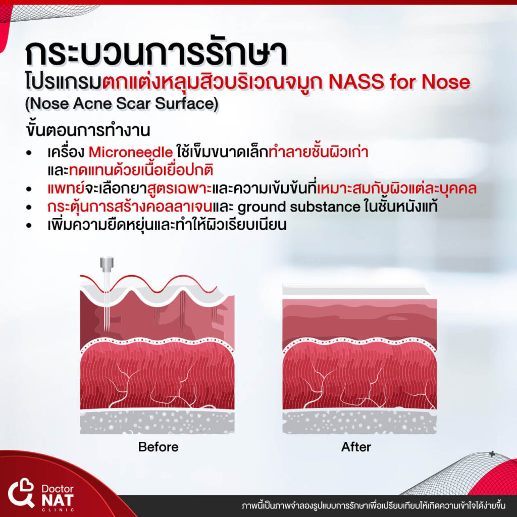 NASS for Nose Surgery Doctor NAT Clinic