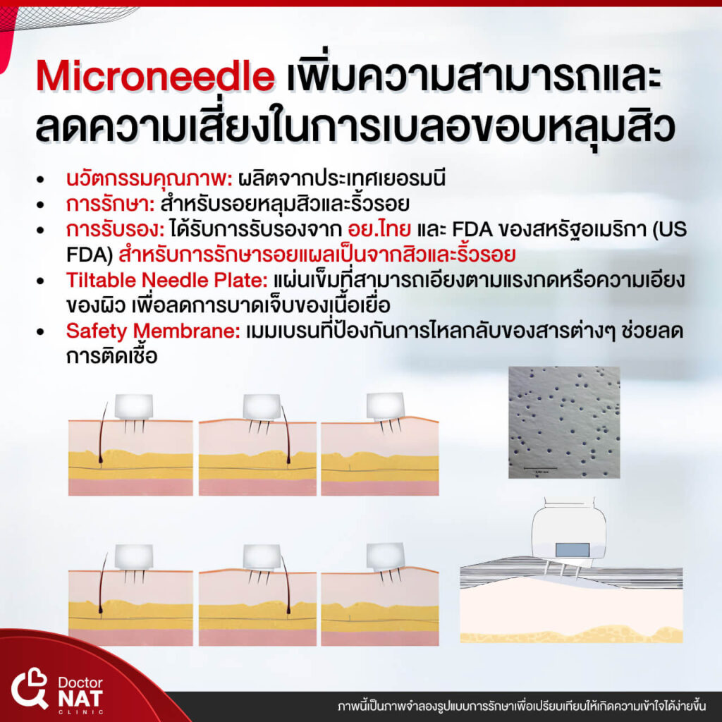 โปรแกรม เบลอขอบหลุมสิว Doctor NAT Clinic