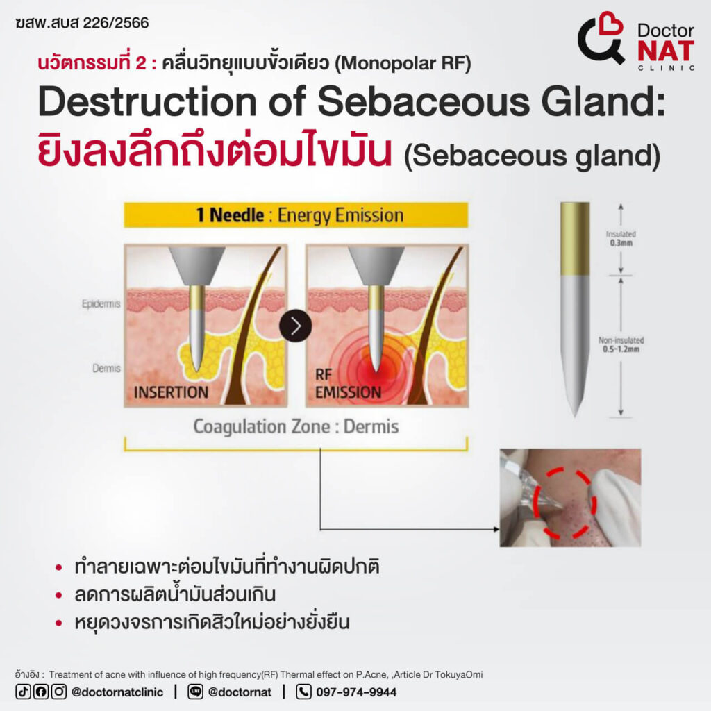 ACCLEAR โปรแกรมรักษาสิว ผสาน 2 เทคโนโลยี