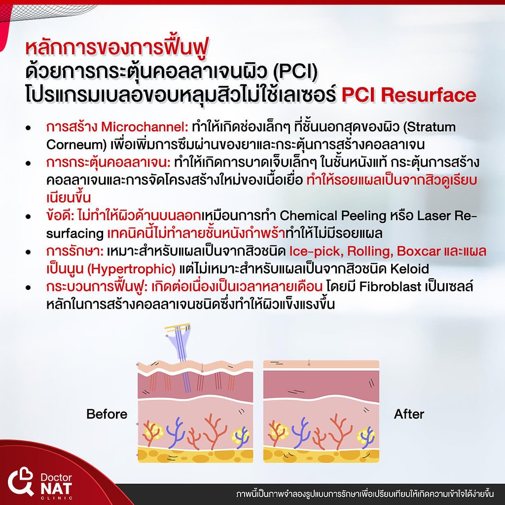 โปรแกรม เบลอขอบหลุมสิว Doctor NAT Clinic