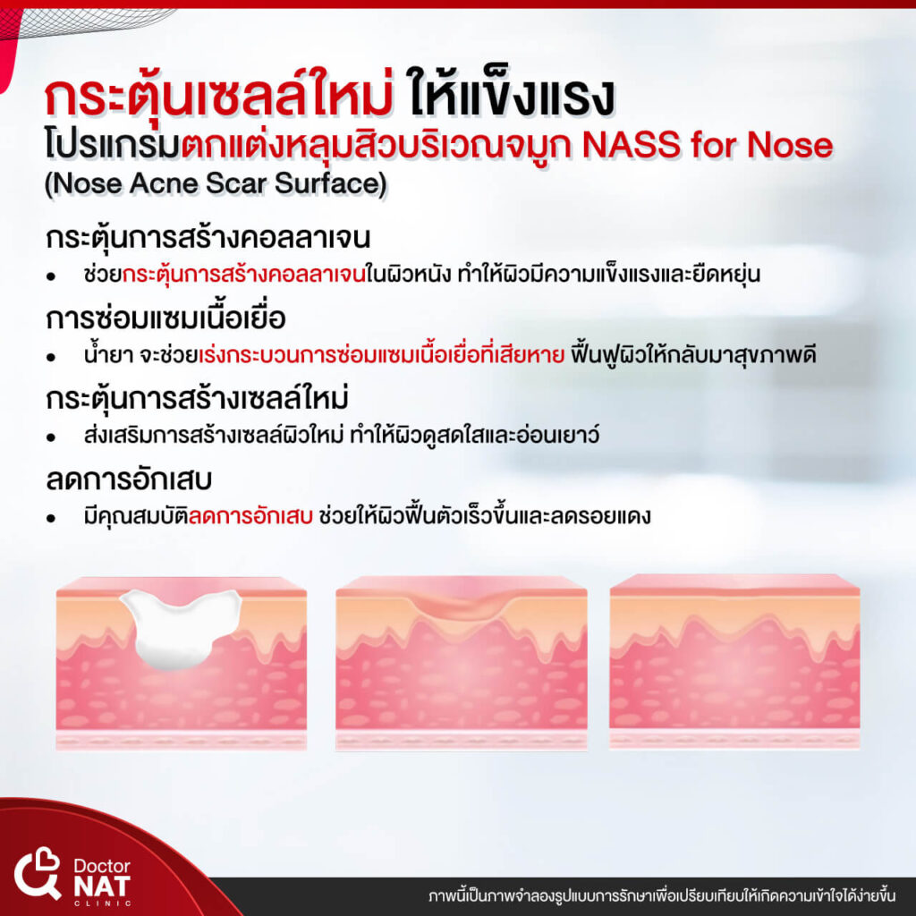 NASS for Nose Surgery Doctor NAT Clinic