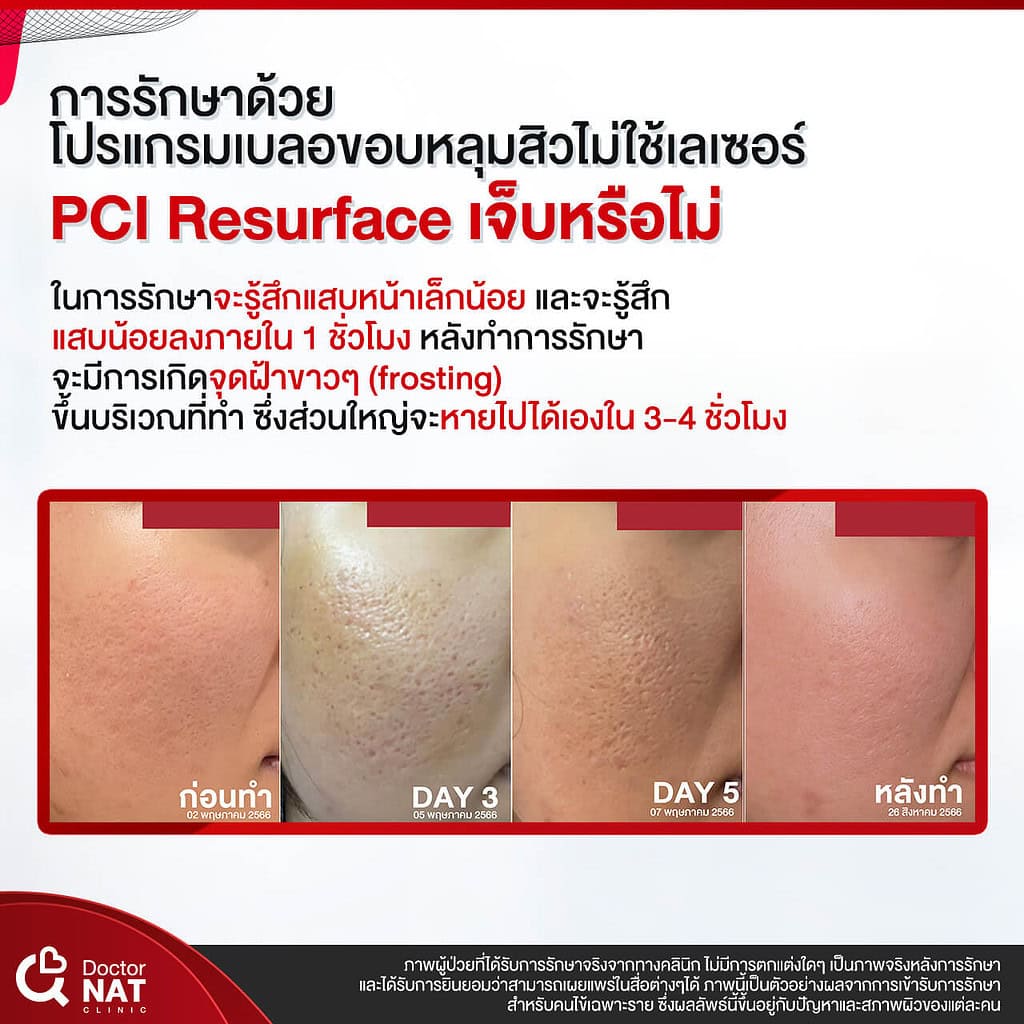 โปรแกรม เบลอขอบหลุมสิว Doctor NAT Clinic