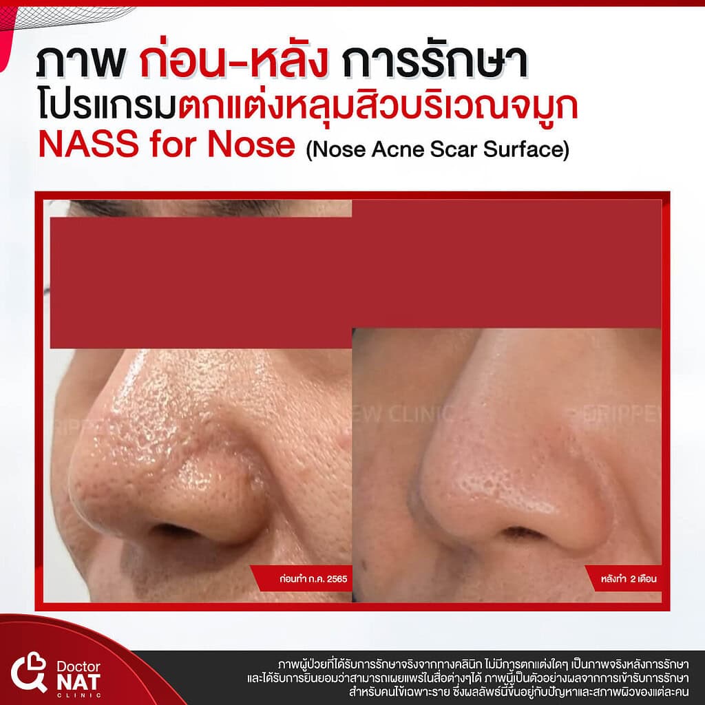 ภาพก่อน-หลังทำ หลุมสิวบริเวณจมูก Doctor NAT Clinic