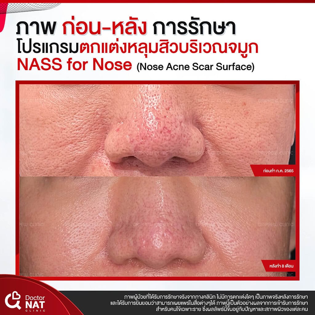 ภาพก่อน-หลังทำ หลุมสิวบริเวณจมูก Doctor NAT Clinic