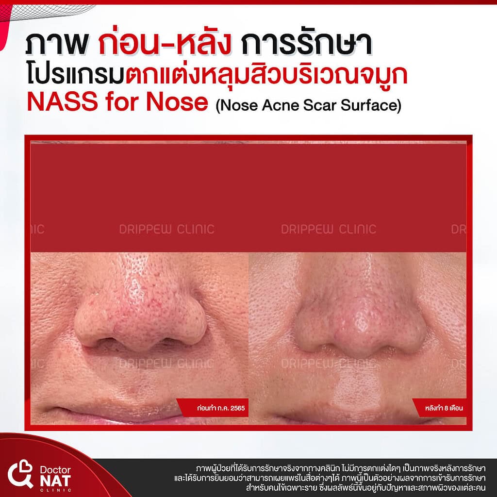 ภาพก่อน-หลังทำ หลุมสิวบริเวณจมูก Doctor NAT Clinic