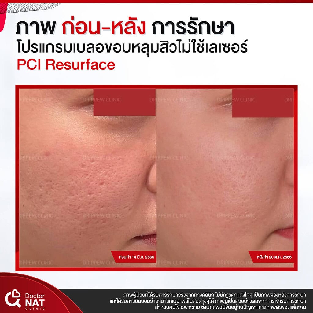 ภาพก่อน-หลัง การรักษา โปรแกรม เบลอขอบหลุมสิว Doctor NAT Clinic