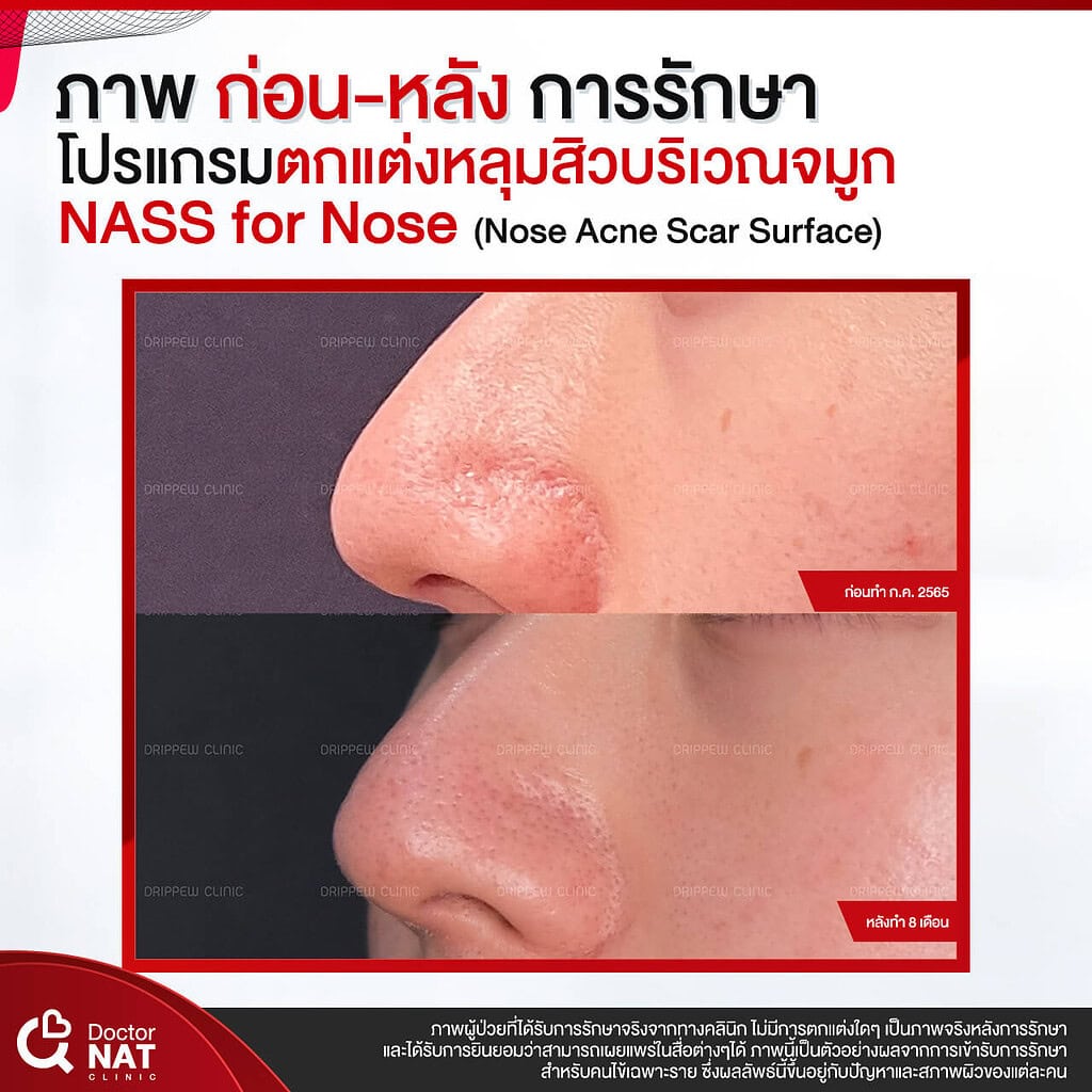 ภาพก่อน-หลังทำ หลุมสิวบริเวณจมูก Doctor NAT Clinic