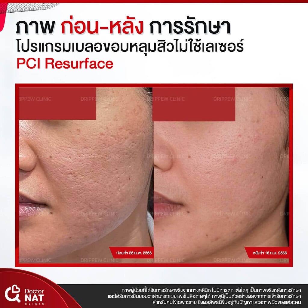 ภาพก่อน-หลัง การรักษา โปรแกรม เบลอขอบหลุมสิว Doctor NAT Clinic