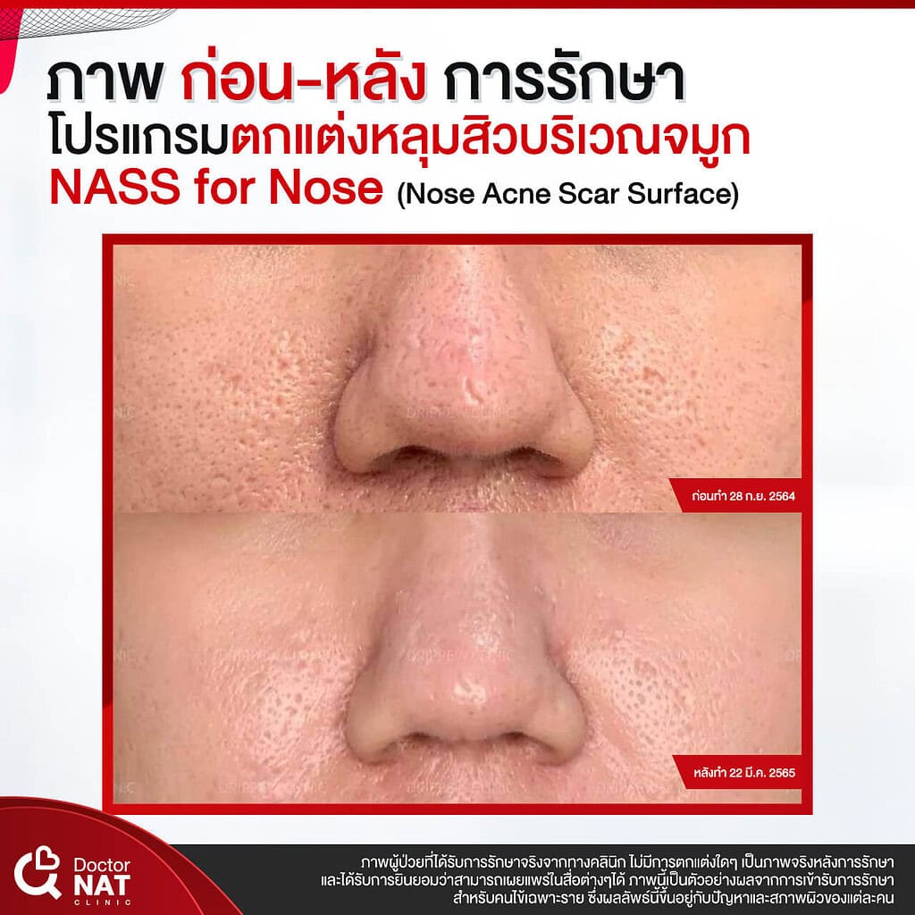 ภาพก่อน-หลังทำ หลุมสิวบริเวณจมูก Doctor NAT Clinic