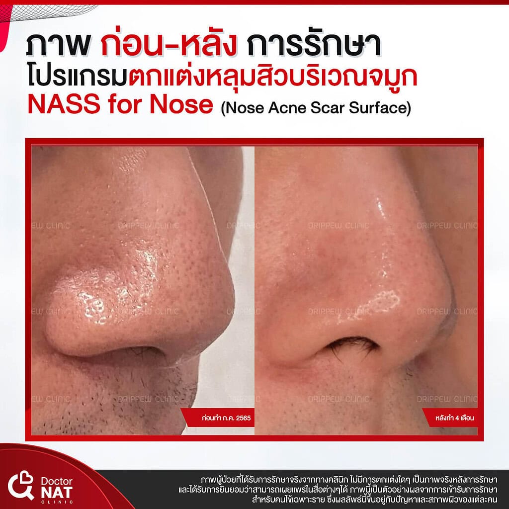 ภาพก่อน-หลังทำ หลุมสิวบริเวณจมูก Doctor NAT Clinic
