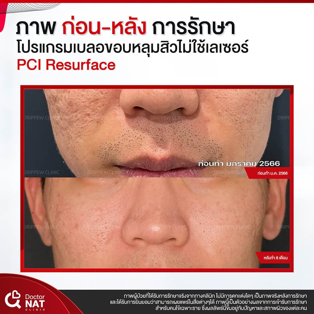 ภาพก่อน-หลัง การรักษา โปรแกรม เบลอขอบหลุมสิว Doctor NAT Clinic