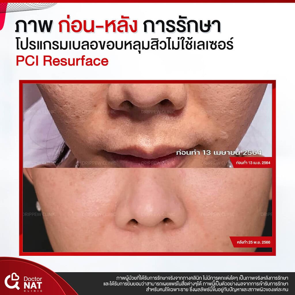 ภาพก่อน-หลัง การรักษา โปรแกรม เบลอขอบหลุมสิว Doctor NAT Clinic