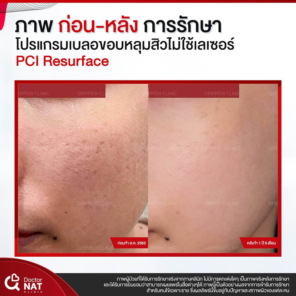 ภาพก่อน-หลัง การรักษา โปรแกรม เบลอขอบหลุมสิว Doctor NAT Clinic