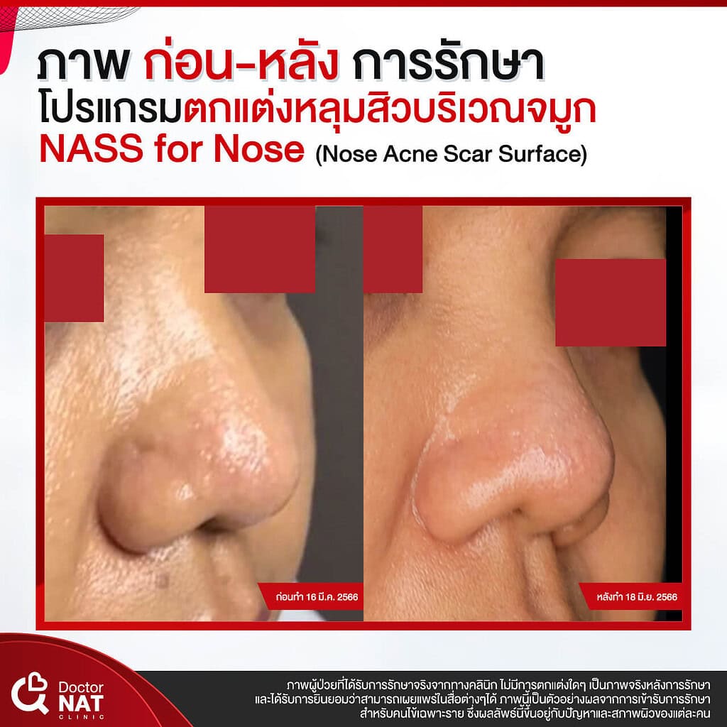 ภาพก่อน-หลังทำ หลุมสิวบริเวณจมูก Doctor NAT Clinic