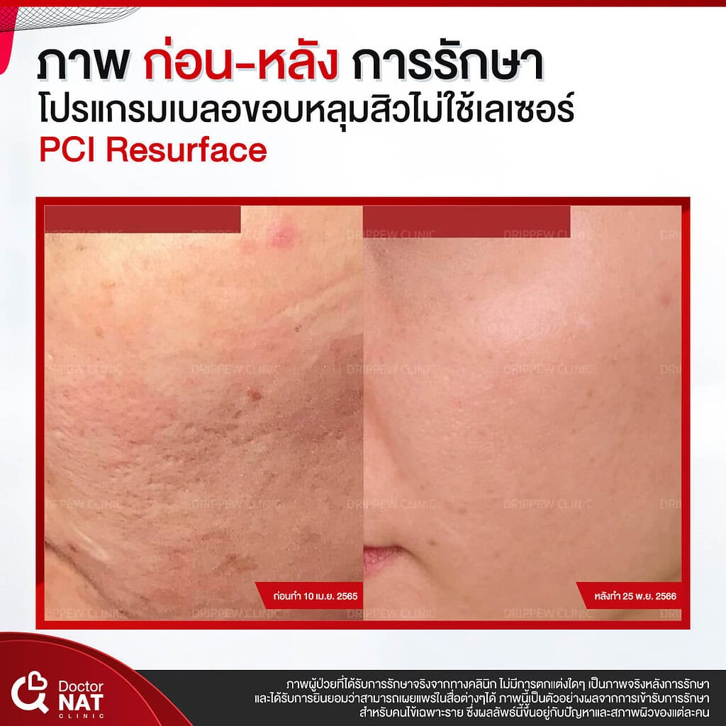 ภาพก่อน-หลัง การรักษา โปรแกรม เบลอขอบหลุมสิว Doctor NAT Clinic