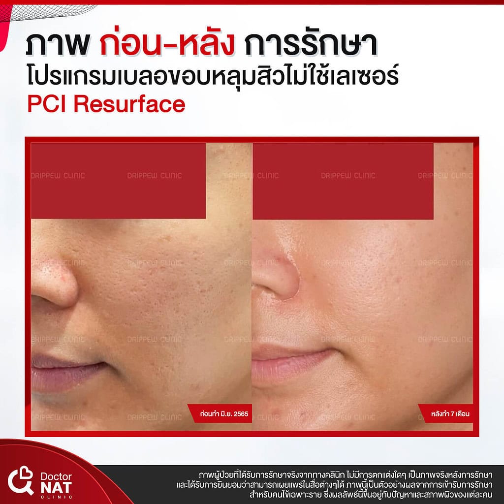 ภาพก่อน-หลัง การรักษา โปรแกรม เบลอขอบหลุมสิว Doctor NAT Clinic