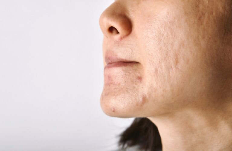 รักษาหลุมสิวที่ไหนดี หลุมสิวให้หายได้จริง