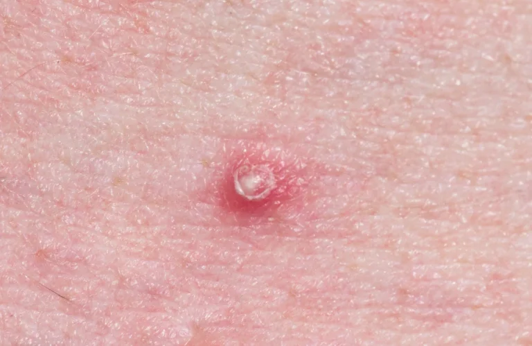 สิวหัวขาว คืออะไร เกิดจากอะไร?