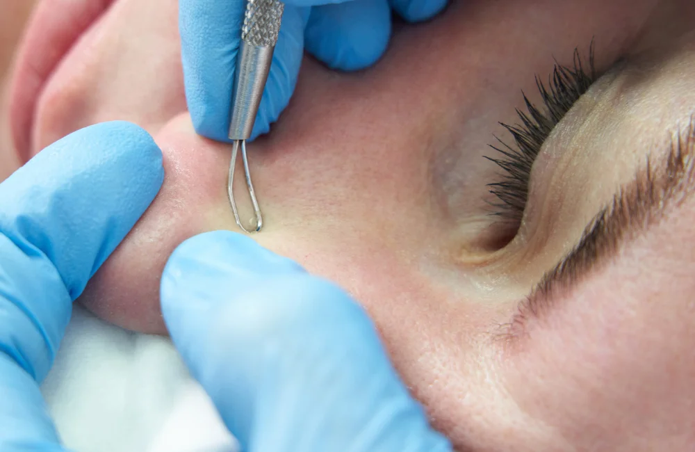 วิธีรักษาสิวหัวขาว