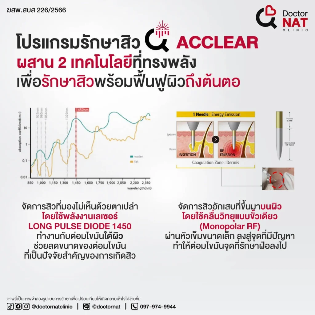 รักษาสิวด้วยโปรแกรม Acclear