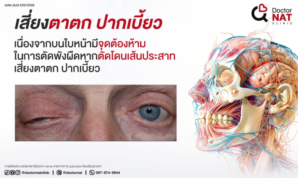 ตัดพังผืดหลุมสิว Danger area of Subcision