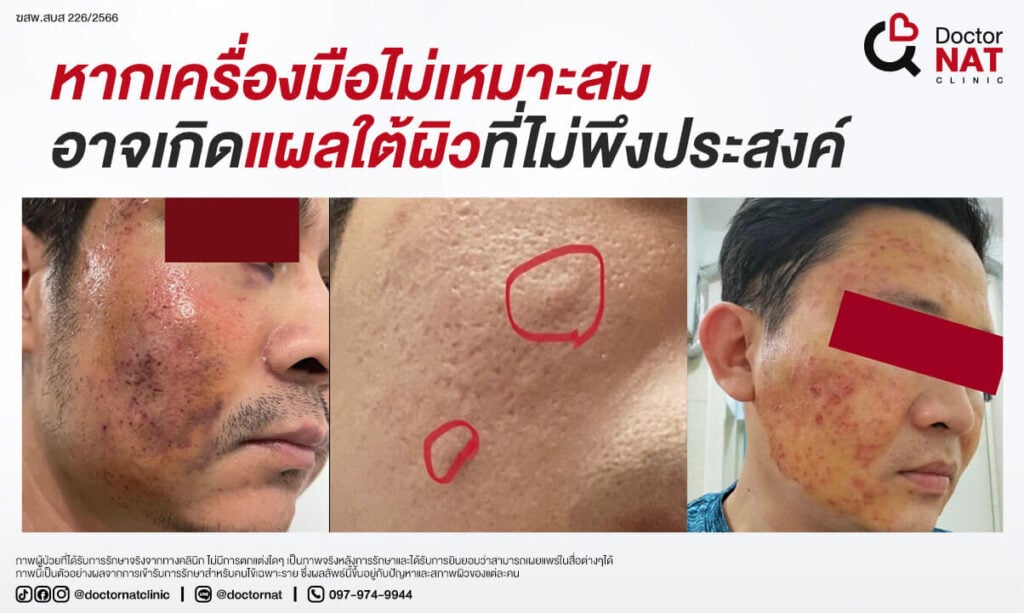ตัดพังผืด เสี่ยงปากเบี้ยว