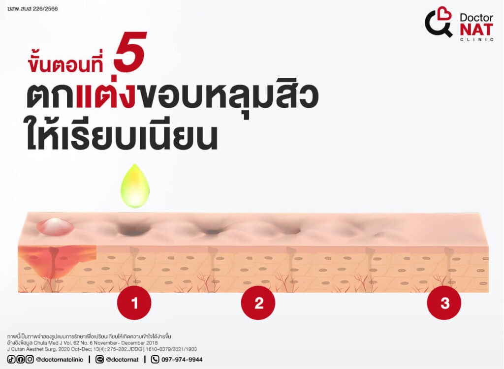 โปรแกรมตัดพังผืดหลุมสิว MASS Full Step