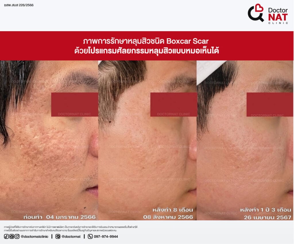 ก่อน - หลัง การผ่าตัดพังผืดหลุมสิว หมอแนท