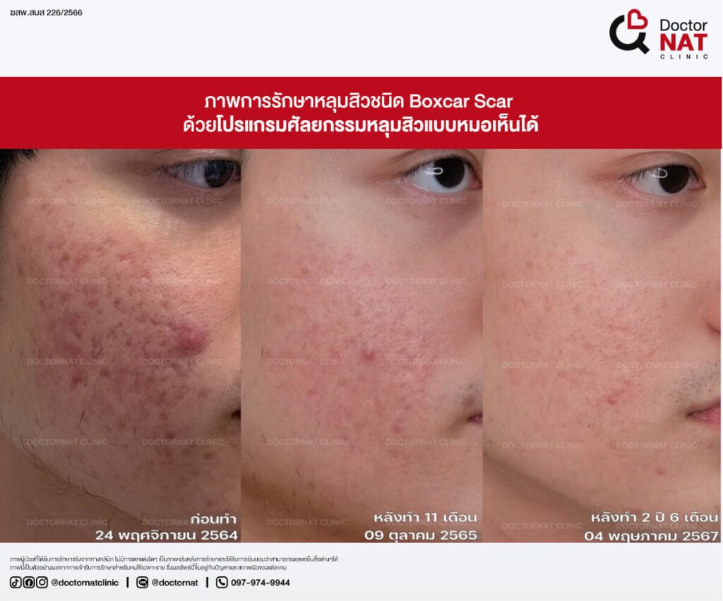 ก่อน - หลัง การผ่าตัดพังผืดหลุมสิว หมอแนท