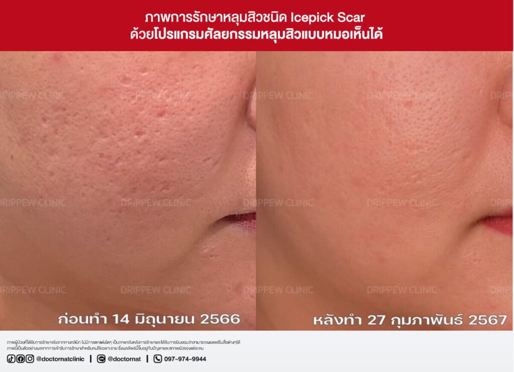 ก่อน - หลัง การผ่าตัดพังผืดหลุมสิว หมอแนท
