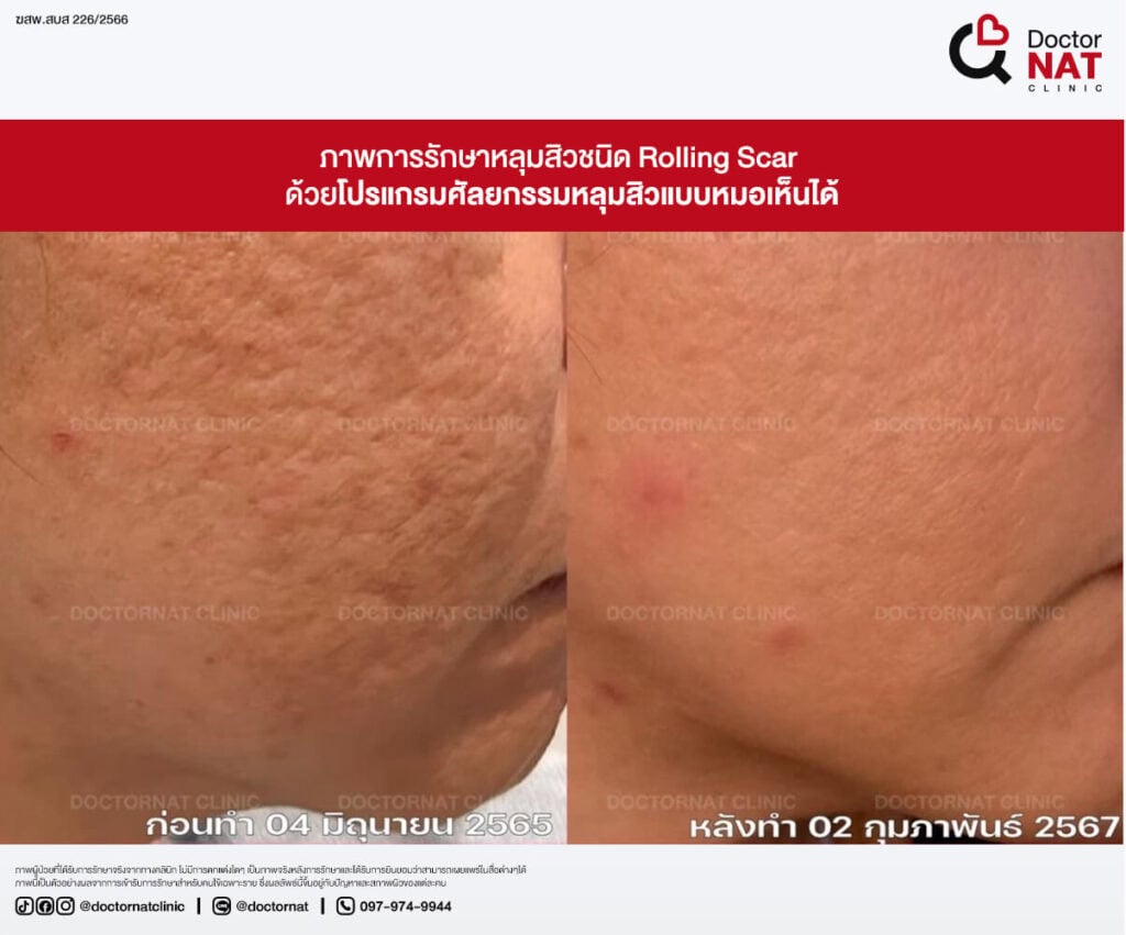 ก่อน - หลัง การผ่าตัดพังผืดหลุมสิว หมอแนท
