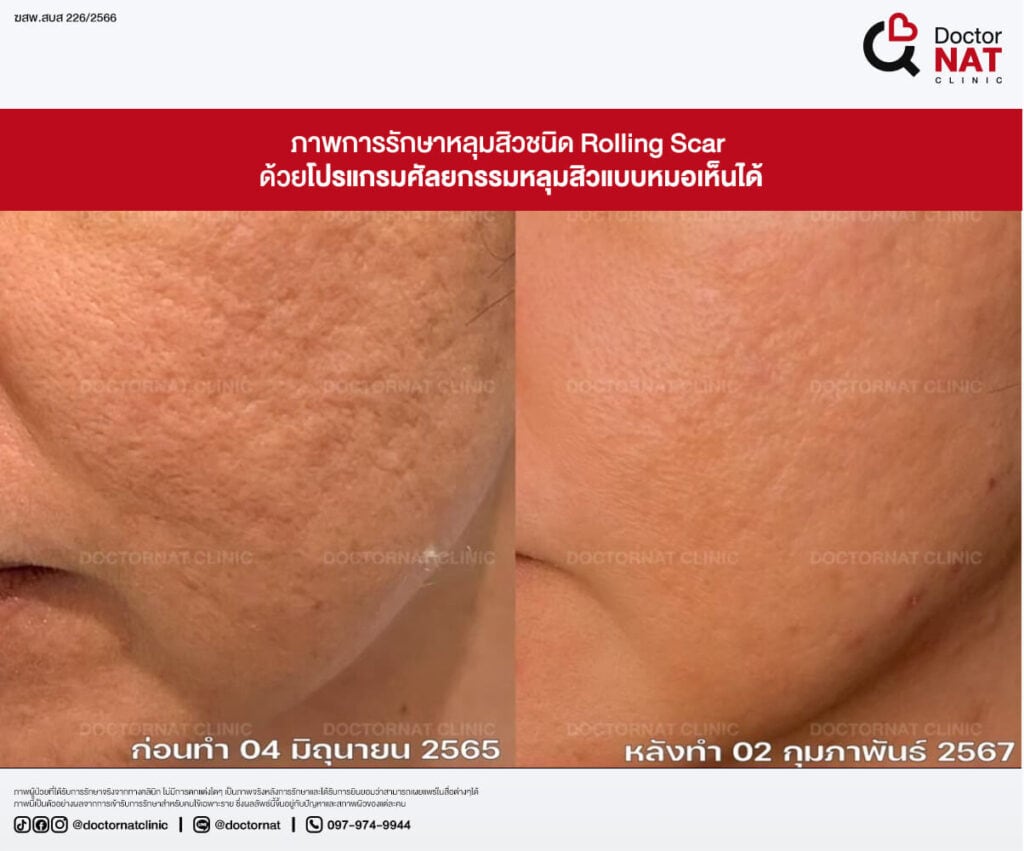ก่อน - หลัง การผ่าตัดพังผืดหลุมสิว หมอแนท