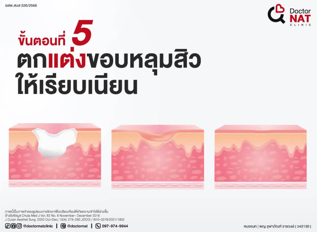 โปรแกรมตัดพังผืดหลุมสิว MASS Full Step