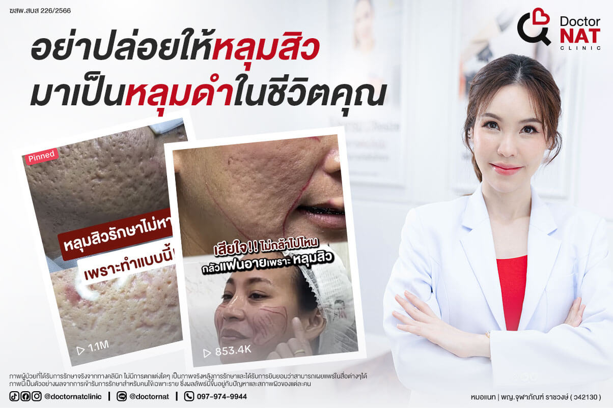 รักษาหลุมสิวมาหลายวิธี ยิ่งรักษายิ่งแย่จนถอดใจ