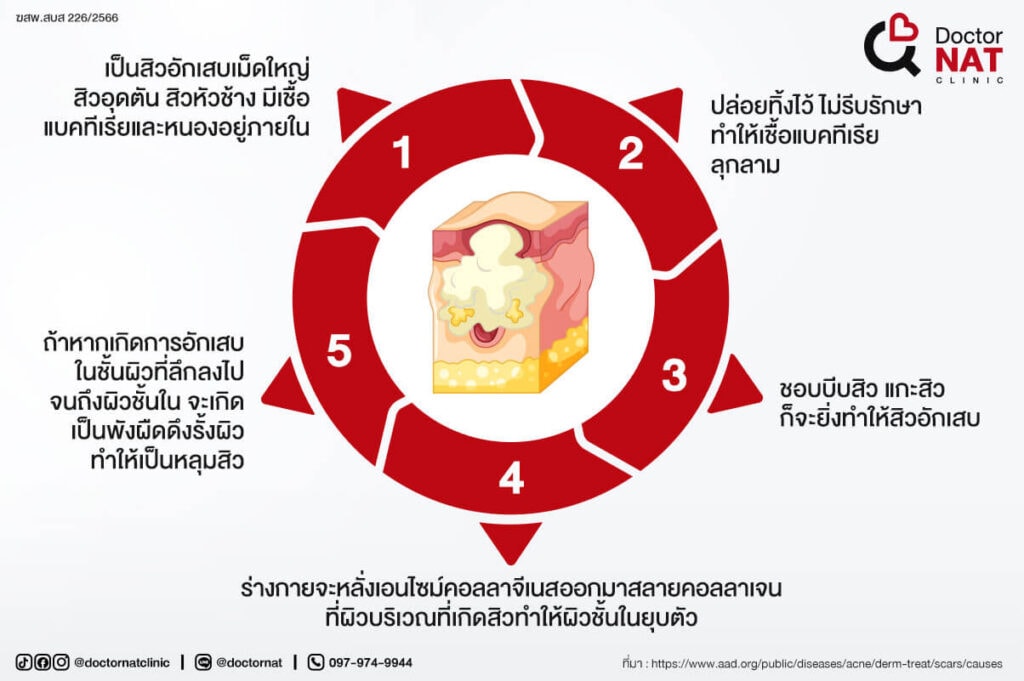 สาเหตุของหลุมสิว