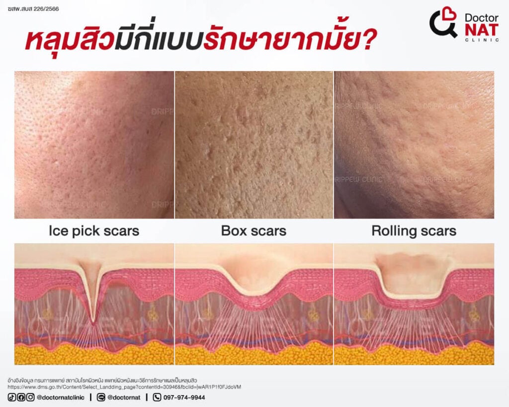 หลุมสิวมีกี่แบบ