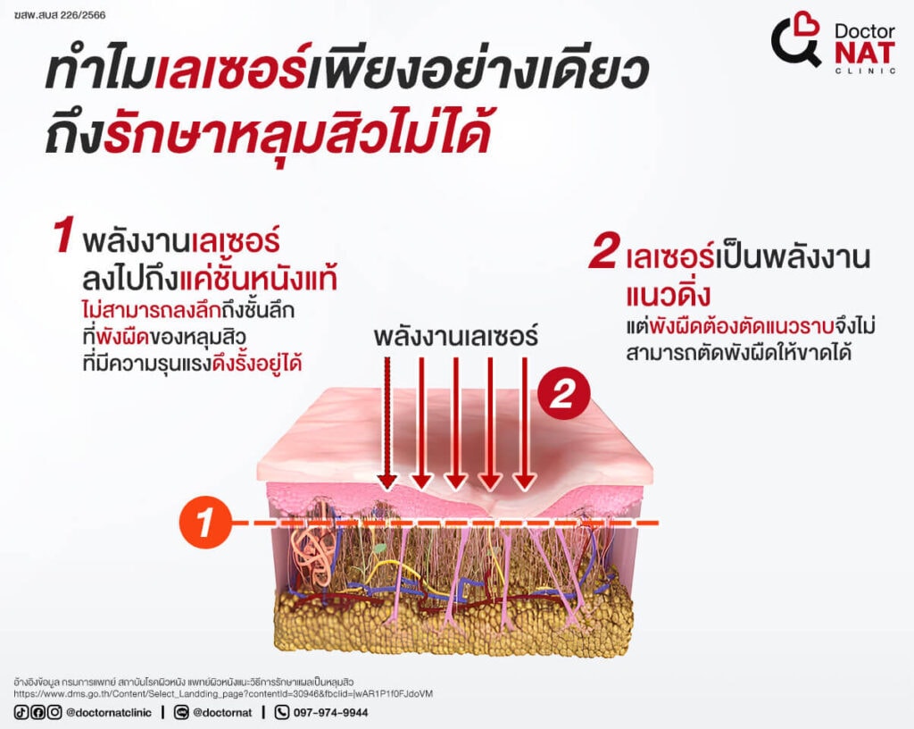 ทำไมเลเซอร์รักษาหลุมสิวไม่ได้