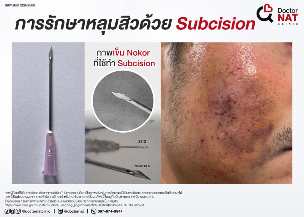 การรักษาหลุมสิวด้วย Subcision