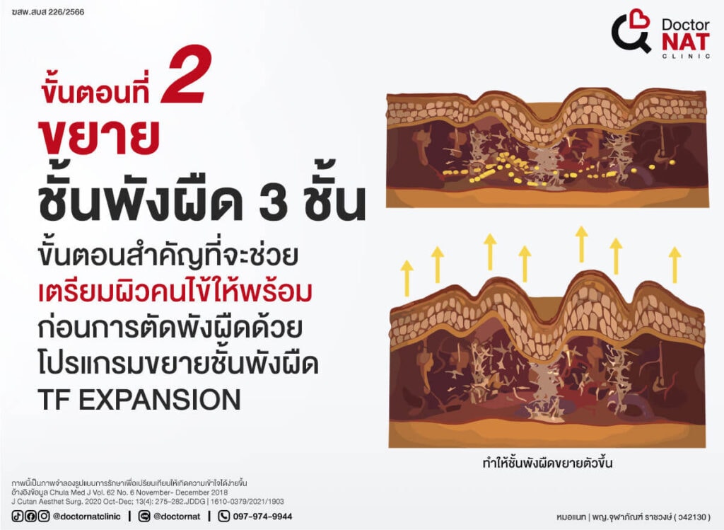 โปรแกรมตัดพังผืดหลุมสิว MASS Full Step