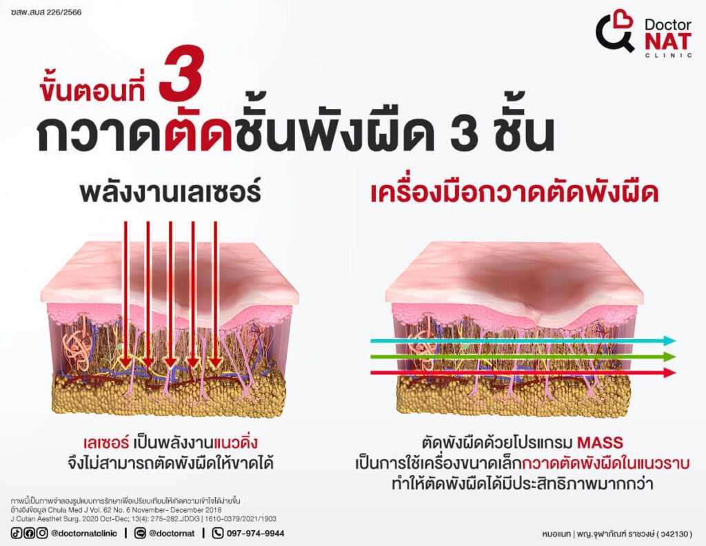โปรแกรมตัดพังผืดหลุมสิว MASS Full Step