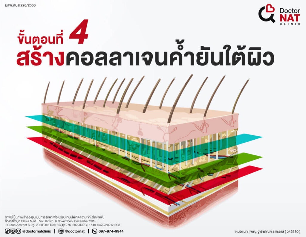 โปรแกรมตัดพังผืดหลุมสิว MASS Full Step