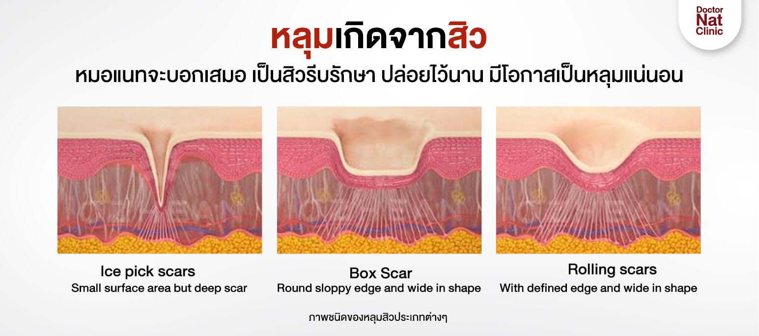 ประเภทของหลุมสิว